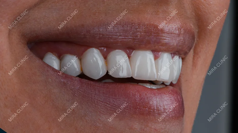Hollywood Smile